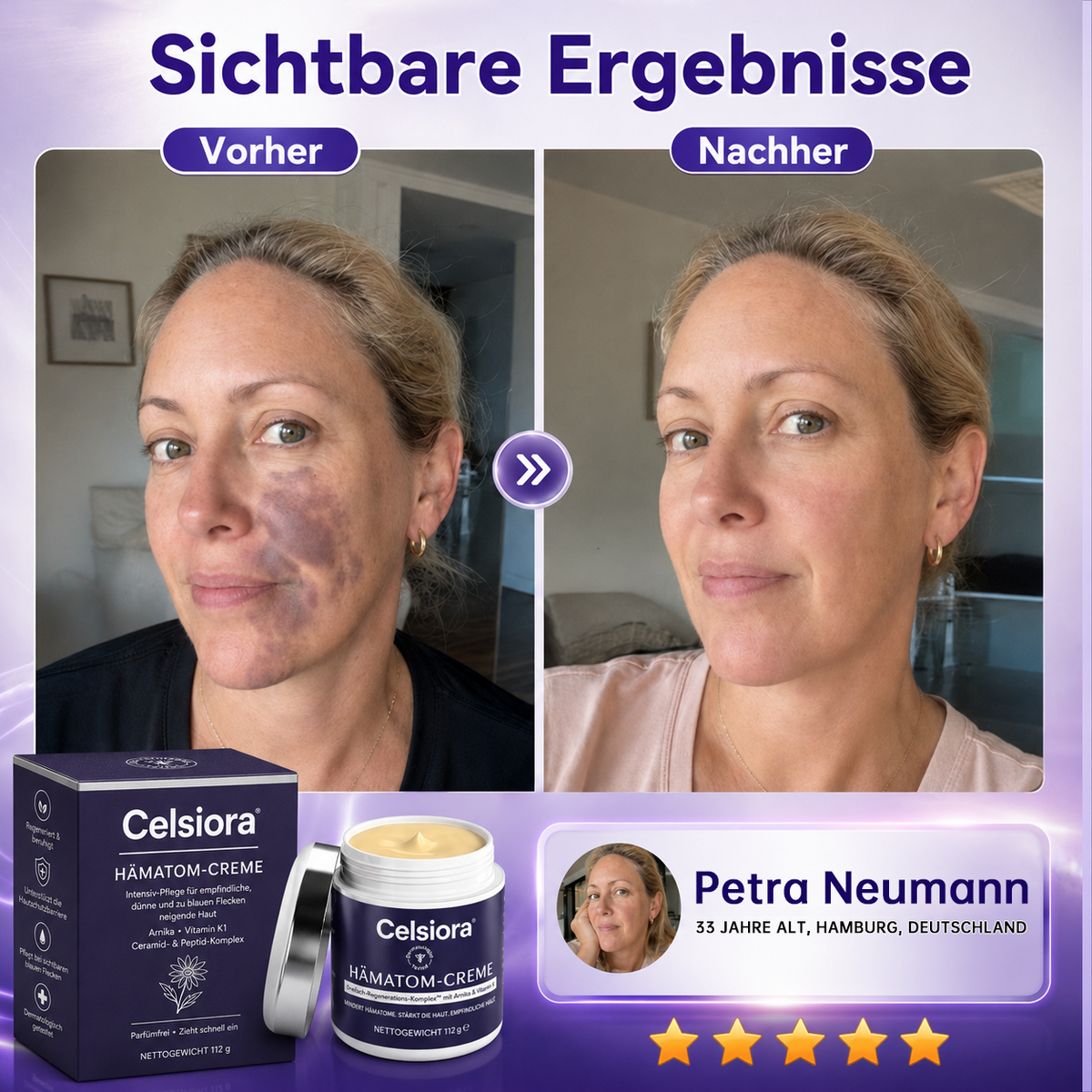 👩‍⚕️🌷 Celsiora® Intensiv-Pflegecreme für empfindliche, zu blauen Flecken neigende Haut